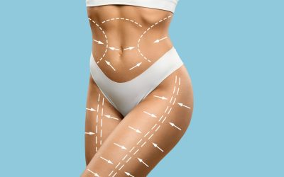 Liposuction in Nairobi